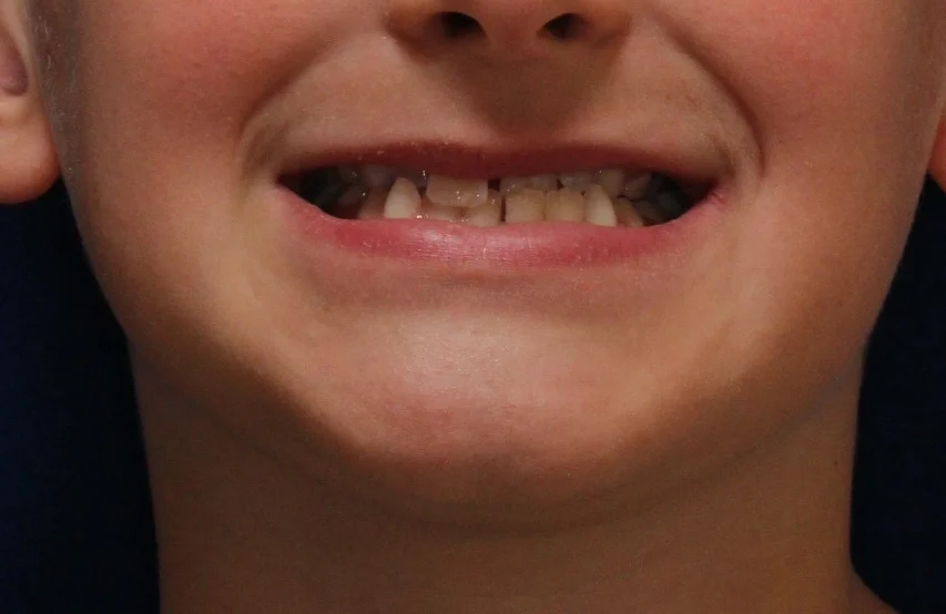 9-Year Old Patient Completes Orthodontic Treatment